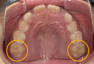 第一大臼歯が萌出している