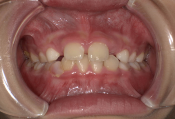 切歯（前歯）のうち少なくとも2歯が2/3以上萌出している