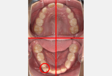 3/4顎に乳歯または未萌出の永久歯が2本以上ある