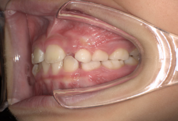 乳犬歯と第1乳臼歯・第2乳臼歯の乳歯が残っている