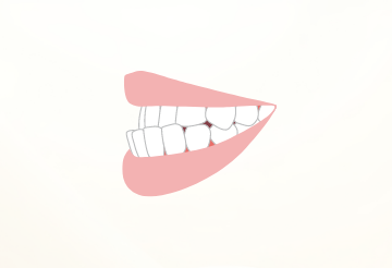 受け口（反対咬合）