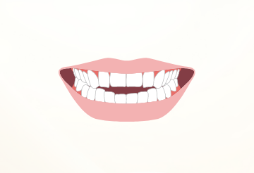 開咬（オープンバイト）