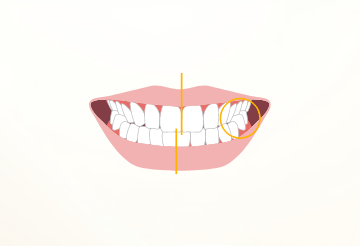 交叉咬合（クロスバイト）