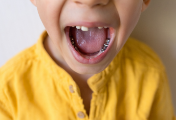 金属アレルギーでも矯正ができる