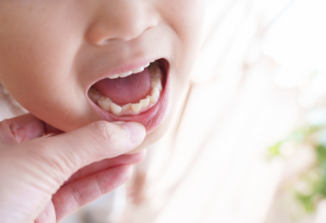 重度の歯列不正（ガタガタの歯並び）