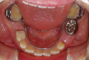 リンガルアーチ