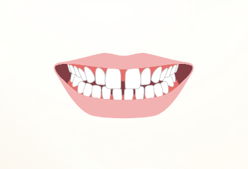 空隙歯列（すきっ歯）
