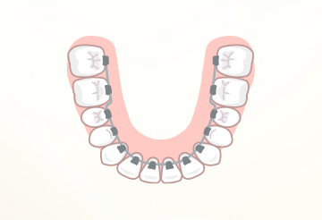裏側矯正（リンガル矯正）