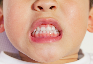 永久歯のスペースを確保