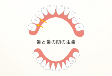 奥歯と奥歯の間