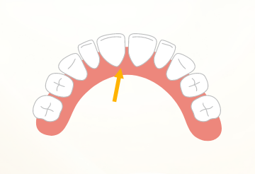 上顎の前歯と前歯の間